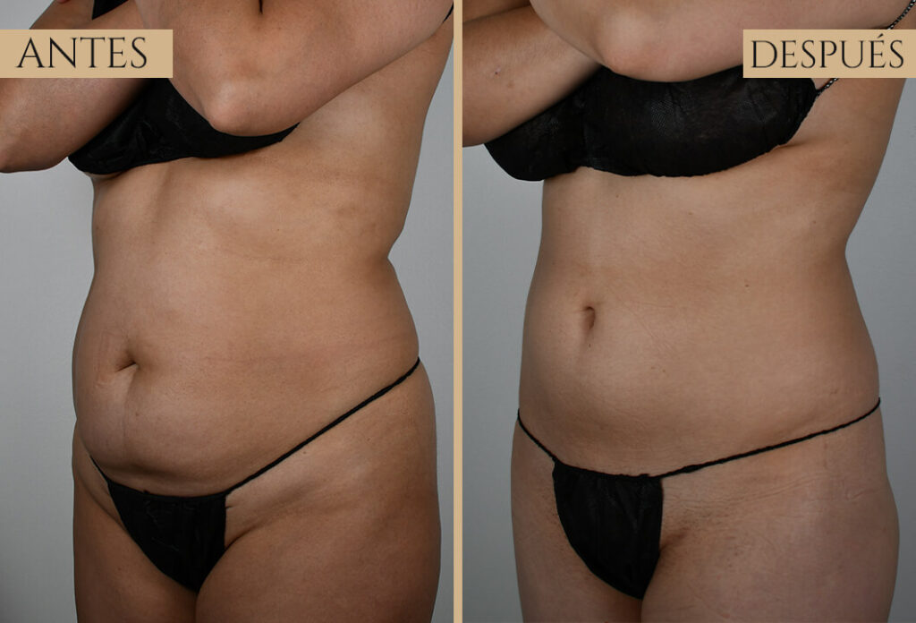 Antes-despues exp 1 (3)