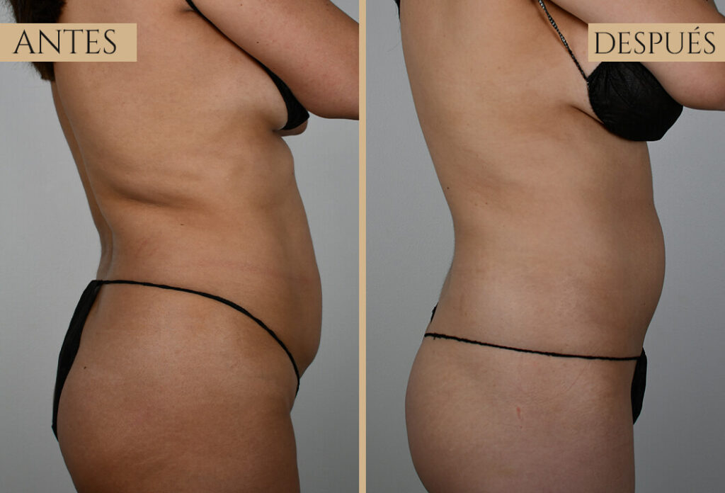 Antes-despues exp 1 (4)