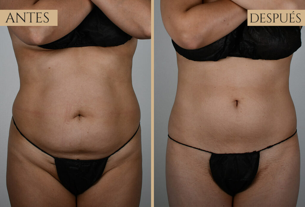 Antes-despues exp 1 (5)