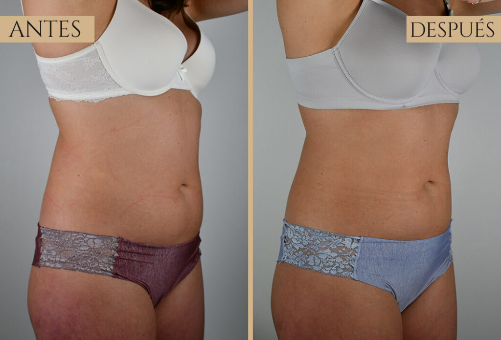 Antes-despues exp 2 (1)