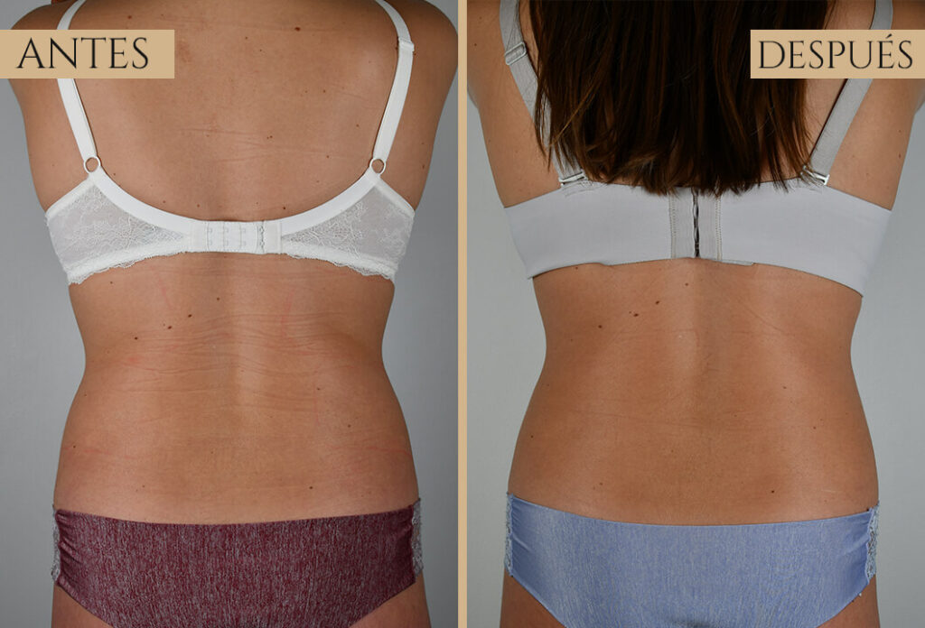 Antes-despues exp 2 (3)
