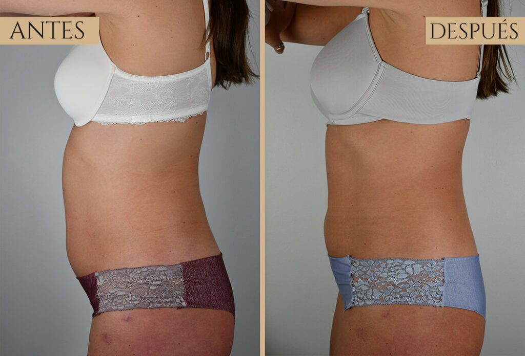 Antes-despues exp 2 (4)