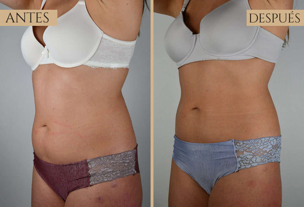 Antes-despues exp 2 (5)