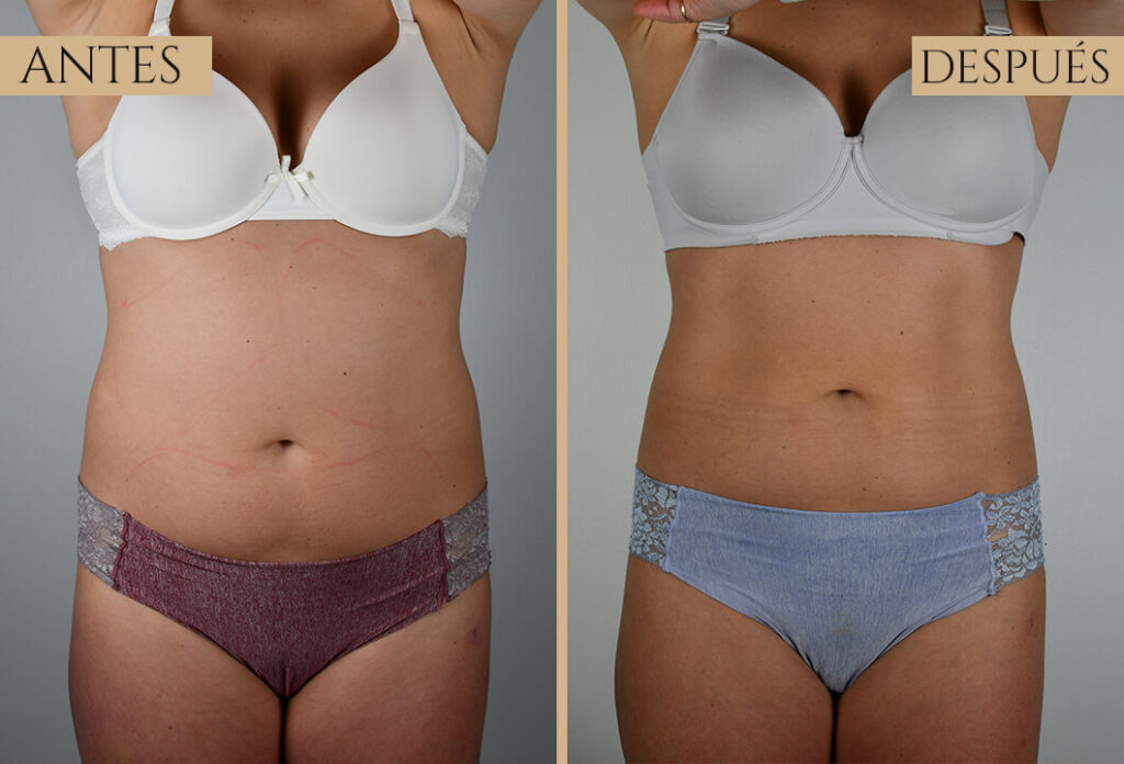 Antes-despues exp 2 (6)